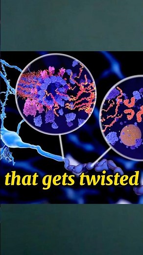 The Twisted Truth About CTE Brain Tangles