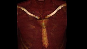 How to perform a direct axillary artery cannulation