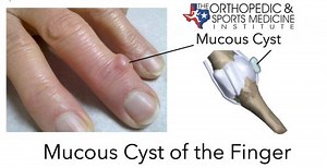 Mucous Cyst of the Finger