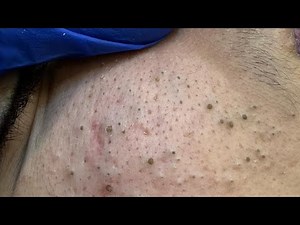 Ultimate Acne Removal Regimen – Deep & Effective Remedies!