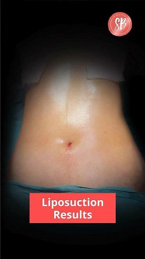 Liposuction Before After Results | Liposuction Surgery | Liposuction Treatment | SB Aesthetics
