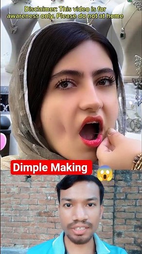 How Dimples Are Made by Surgery 😳