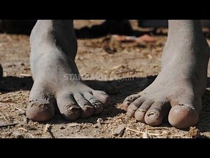 Jiggers pose a threat to children in Western Kenya forcing them to drop out