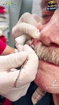 Pebble like Cyst Drained by Dr. H.L. Greenberg at Las Vegas Dermatology®