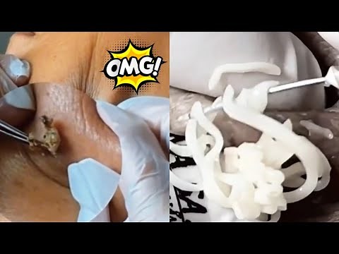Ultimate Pimple Popping Compilation: Satisfying Blackhead and Cyst Extractions