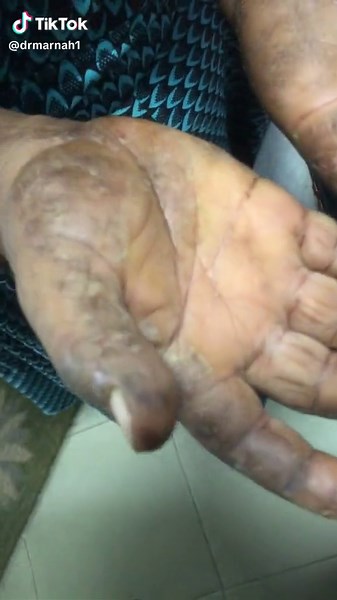 Understanding and Treating Peeling Hands: Causes and Solutions