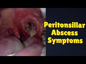 Peritonsillar Abscess Symptoms