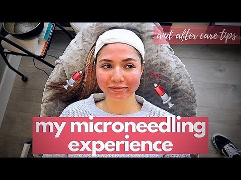 MICRONEEDLING PROCEDURE - aftercare tips, skin updates, before and after
