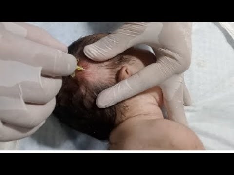 💉 Newborn Baby Head IV Line Protocol | Safe NICU Nurse Care | Warmer & Incubator Support