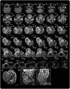 Gadolinium Deposition in the Brain