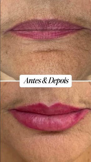 Preenchimento Labial | Antes e Depois | Clínica Fisioderme Brasília