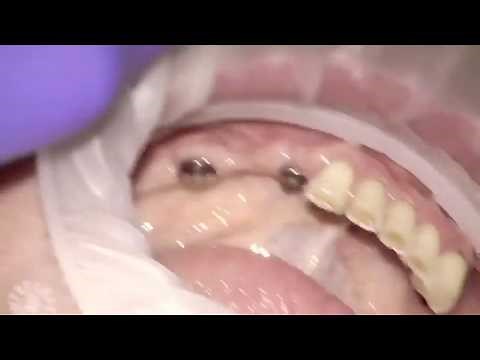 Straumann Bone and Tissue Level dental implant closed tray impression technique