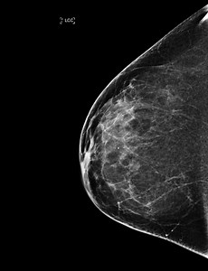 Mammogram - Normal