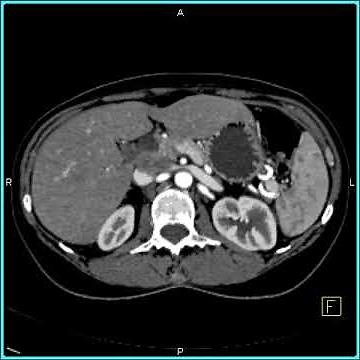 Abdomen: Stomach: SMA Syndrome: Vascular mapping(7 of 7)