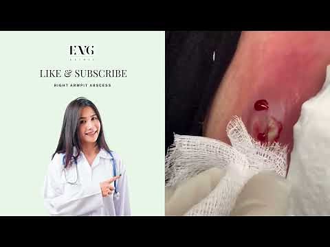 Right armpit abscess