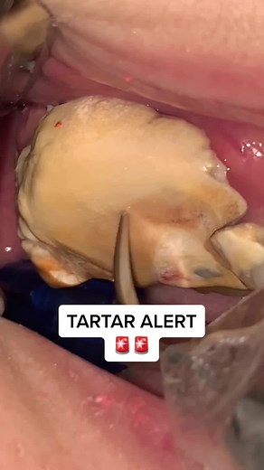 HOW MANY 🦷 ARE HIDDEN?! Tartar Alert🚨This is severe Tartar build up aka calculus on the teeth. Major teeth cleaning with calculus removal shown here! Tartar can only be removed by a dentist or hygienest. Tartar is hardened plaque that is stuck on the teeth like calcified rock⚠️ It’s a mix of bacteria, food, & minerals from saliva. This severe case comes from years of not brushing properly. This can cause gum disease, infection, & bad breath😷#dentist #teeth #tooth #tartar teeth cleaning plaque