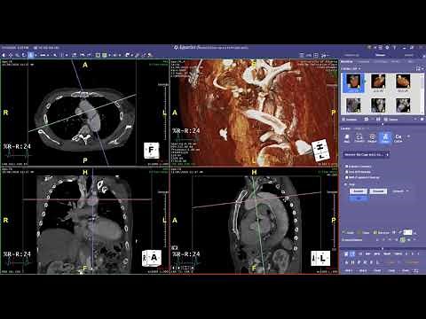 Thoracic Endovascular Aortic Repair (TEVAR)