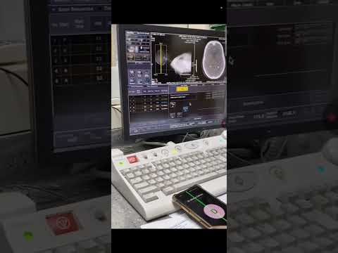 CT Brain Perfusion & 4 Vessel Angio | Stroke Imaging on Canon CT Scanner”