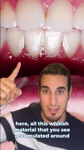 GINGIVITIS treatment and symptoms - INFLAMED GUMS and GUM DISEASE