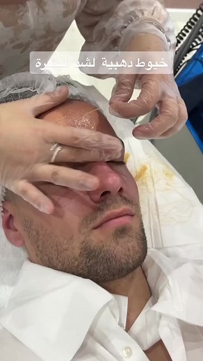 Facial Thread Lift using Gold Threads