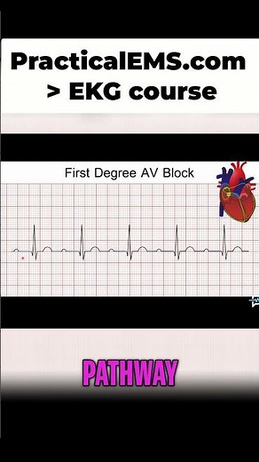 First Degree AV Block: ECG Interpretation Made Easy