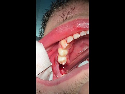 How to pull a broken tooth - First Molar extraction - قلع جراحي