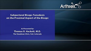 Subpectoral Biceps Tenodesis on the Proximal Aspect of the Biceps