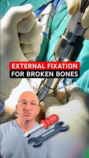 External Fixation For Fractured Bones #shorts