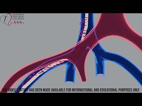 ECMO-Recirculation complication