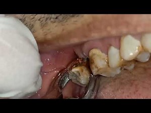 Exodontia Badly Decayed Upper Wisdom