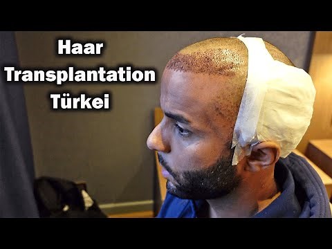 Haartransplantation Türkei | Erfahrungen bei Dr. Serkan Aygin