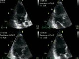 Dobutamine Stress Echocardiogram • Video • MEDtube.net