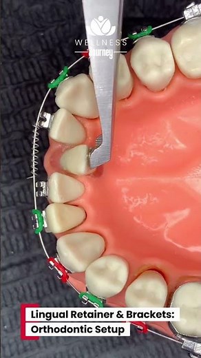 Lingual Retainer & Brackets: Orthodontic Setup 🪄