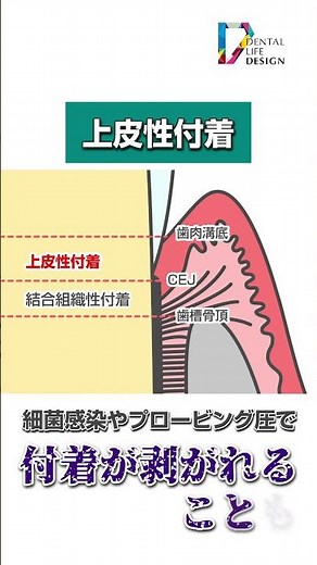 [Please tell me the meaning of connective tissue attachment and epithelial attachment (connective...