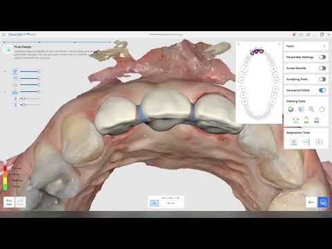 Medit ClinicCAD app - simple 3-unit bridge design walkthrough