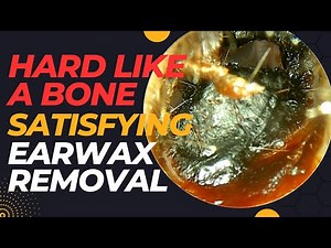 Very Hard Like A BONE Satisfying Earwax Removal