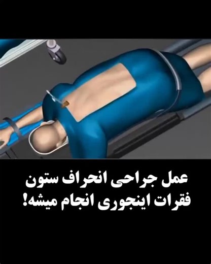 ‎آشپزباشی‎ on Instagram‎: "❌ برای درمان کمردرد به هیچ وجه جراحی نکنید ! ❌ ⚠️از وقتی میشه با استفاده از تکنولوژی امواج درمانی در کمتر از “ ۲۱ روز ” کمردرد رو درمان کرد، هیچ کس دیگه کمرش رو جراحی نمیکنه‼️ ✅پیج زیر رو فالو کن و مشاوره رایگان بگیر ✅ @uic.platiner @uic.platiner @uic.platiner @uic.platiner @uic.platiner @uic.platiner @uic.platiner"‎
