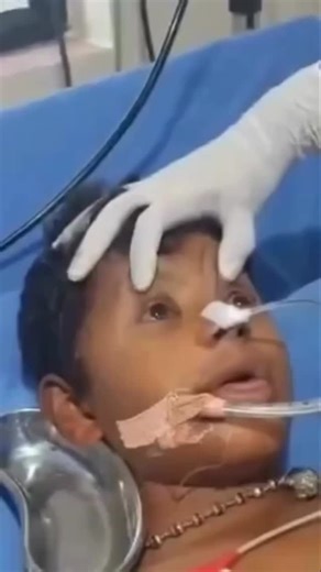 360°medico on Instagram: "The test used to assess brain death, especially in the absence of a brainstem response, is the Caloric Reflex Test, which assesses the synergistic reflex between the inner ear and the eye. The external auditory canal is injected with cold or warm water: When using warm water (44°C), the eye moves in the opposite direction of the water spray, while nystagmus occurs in the same direction as the water spray. When using cold water (30°C), the eye moves in the direction of t