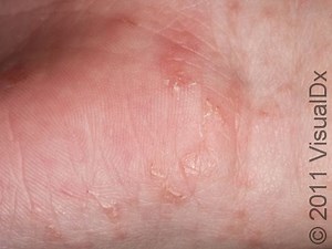 Scabies: Symptoms, Treatment, and Prevention