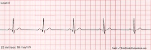 Sinus Bradycardia ECG/EKG Rhythm NCLEX Quiz