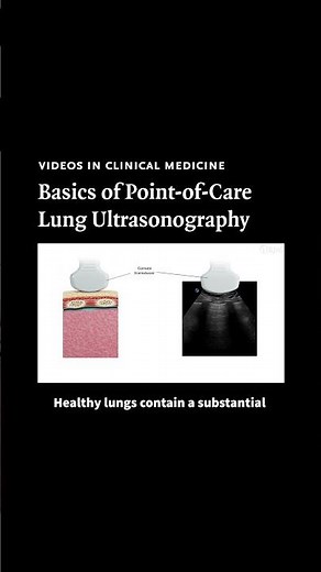 Basics of Point-of-Care Lung Ultrasonography (Features of a Normal Lung on Ultrasonography) | NEJM