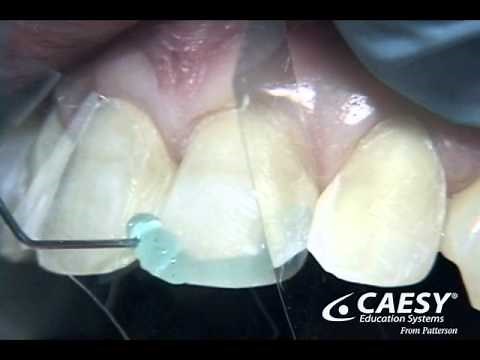Tooth bonding