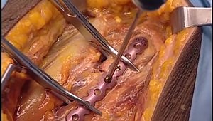 MatrixRIB™ Fixation System Technique