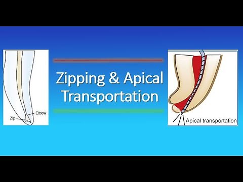 Zipping and Apical Transportation in Endodontics?