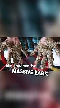 The Tree Man A Rare Genetic Anomaly