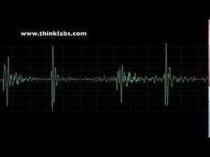 Restrictive Muscular Ventricular Septal Defect