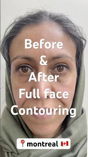 Full Face Contouring – Before & After Transformation!