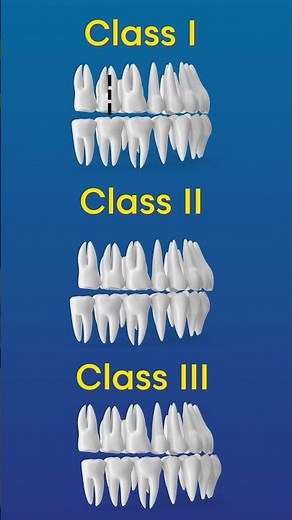 Angle's Classification of Malocclusion