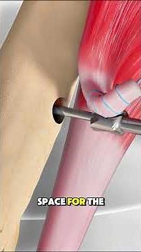 What Happens During Distal Biceps Repair?