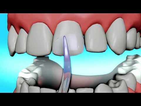 Dental Bonding Video | Tooth Bonding